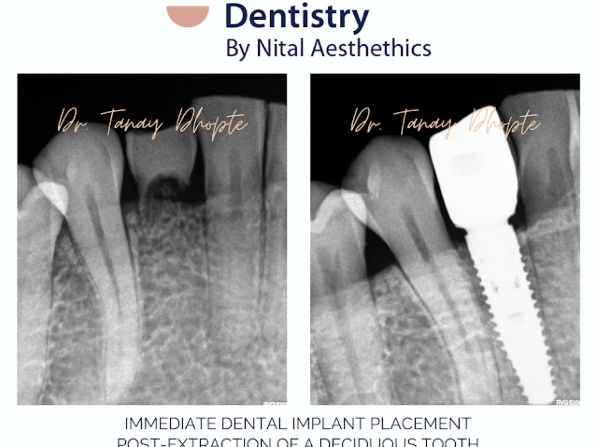 How much do dental implants cost in Vadodara? An honest breakdown